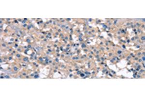 Immunohistochemistry of paraffin-embedded Human thyroid cancer tissue using ZFYVE16 Polyclonal Antibody at dilution of 1:60(x200) (ZFYVE16 Antikörper)