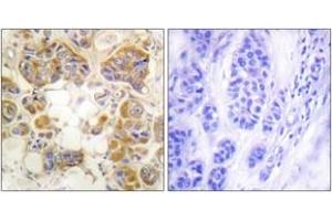 Immunohistochemistry analysis of paraffin-embedded human breast carcinoma tissue, using Collagen I Antibody. (Collagen Type I Antikörper  (AA 1-50))