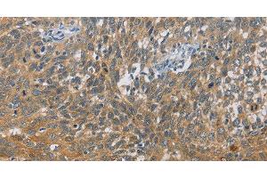 Immunohistochemistry of paraffin-embedded Human cervical cancer tissue using DIO1 Polyclonal Antibody at dilution 1:60 (DIO1 Antikörper)