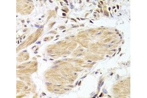 Immunohistochemistry of paraffin-embedded Human gastric cancer using Caspase-2 Polyclonal Antibody at dilution of 1:100 (40x lens). (Caspase 2 Antikörper)