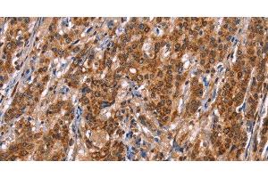 Immunohistochemistry of paraffin-embedded Human gasrtic cancer tissue using TDP2 Polyclonal Antibody at dilution 1:40 (TDP2 Antikörper)