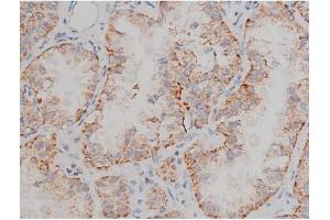 ABIN6267496 at 1/200 staining Human lung cancer tissue sections by IHC-P. (SNCA Antikörper  (pSer129))