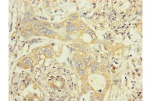 Immunohistochemistry of paraffin-embedded human pancreatic cancer using ABIN7173107 at dilution of 1:100 (TMEM184B Antikörper  (AA 311-407))