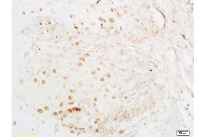 Formalin-fixed and paraffin embedded human esophageal carcinoma labeled with Anti-ELAVL1/HUR Polyclonal Antibody, Unconjugated (ABIN748583) at 1:200 followed by conjugation to the secondary antibody and DAB staining (ELAVL1 Antikörper)