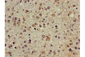 Immunohistochemistry of paraffin-embedded human glioma using ABIN7147710 at dilution of 1:100 (CDYL Antikörper  (AA 8-260))