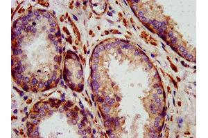 IHC image of ABIN7156872 diluted at 1:1400 and staining in paraffin-embedded human prostate cancer performed on a Leica BondTM system. (IL-24 Antikörper  (AA 52-207))
