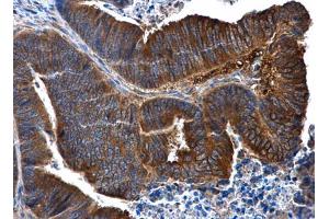 IHC-P Image IL1 Receptor 2 antibody [N3C3] detects IL1 Receptor 2 protein at cytoplasm in human colon cancer by immunohistochemical analysis.
