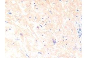 Detection of IL13 in Human Prostate Tissue using Polyclonal Antibody to Interleukin 13 (IL13) (IL-13 Antikörper  (AA 25-146))