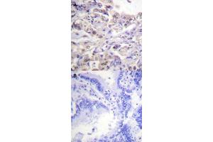 Immunohistochemical staining (Formalin-fixed paraffin-embedded sections) of human lung cancer tissue with HNRNPD (phospho S83) polyclonal antibody  without blocking peptide (A) or preincubated with blocking peptide (B) under 1:50-1:100 dilution. (HNRNPD/AUF1 Antikörper  (pSer83))