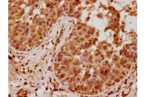 IHC image of ABIN7144464 diluted at 1:740 and staining in paraffin-embedded human breast cancer performed on a Leica BondTM system.