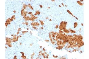Formalin-fixed, paraffin-embedded human Mesothelioma stained with Calretinin Mouse Monoclonal Antibody (CALB2/2602).