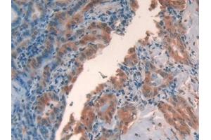 Detection of GAL2 in Human Thyroid cancer Tissue using Polyclonal Antibody to Galectin 2 (GAL2) (Galectin 2 Antikörper  (AA 1-132))