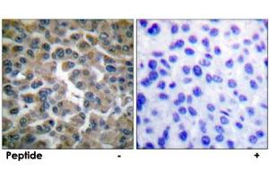 Immunohistochemical analysis of paraffin-embedded human breast carcinoma tissue using NFKBIE polyclonal antibody . (NFKBIE Antikörper)