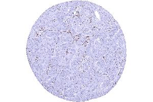 Serous high grade ovarian carcinoma with a complete loss of SMARCA2 expression