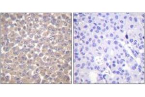 Immunohistochemistry analysis of paraffin-embedded human breast carcinoma tissue, using TRADD Antibody. (TRADD Antikörper  (AA 251-300))