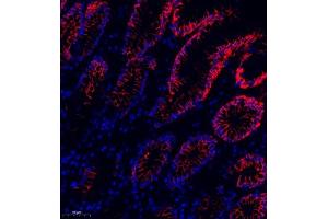 Immunofluorescence of paraffin embedded human colon cancer using MRP1 (ABIN7074544) at dilution of 1:1000 (250x lens) (MRP1 Antikörper)