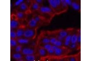 Immunofluorescence analysis of Human liver cancer tissue using ABCB5 Monoclonal Antibody at dilution of 1:200. (ABCB5 Antikörper)