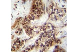 FOXA2 antibody immunohistochemistry analysis in formalin fixed and paraffin embedded human bladder carcinoma. (FOXA2 Antikörper  (AA 134-163))