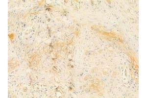 ABIN6262433 and ABIN6277655 at 1/100 staining human tongue carcinoma by IHC-P. (ICAM1 Antikörper  (C-Term))