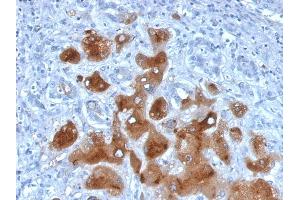 Formalin-fixed, paraffin-embedded human Hepatocellular Carcinoma stained with Serum Amyloid A Mouse Monoclonal Antibody (SAA/326). (SAA Antikörper)