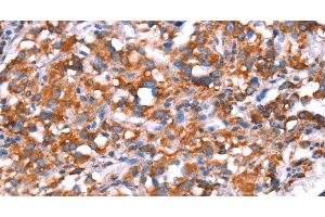 Immunohistochemistry of paraffin-embedded Human thyroid cancer using GH1 Polyclonal Antibody at dilution of 1:40 (Growth Hormone 1 Antikörper)
