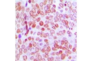 Immunohistochemical analysis of TCF4/12 staining in human prostate cancer formalin fixed paraffin embedded tissue section. (TCF4/12 (C-Term) Antikörper)