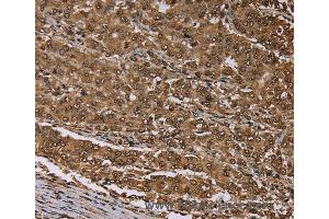 Immunohistochemistry of Human thyroid cancer using MEIS1 Polyclonal Antibody at dilution of 1:30 (MEIS1 Antikörper)