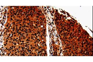 Immunohistochemistry of paraffin-embedded Human renal cancer tissue using ANXA7 Polyclonal Antibody at dilution 1:40 (Annexin VII Antikörper)