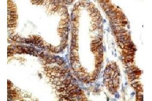 Immunohistochemistry (Formalin-fixed Paraffin-embedded Sections) (IHC (fp)) image for anti-Cadherin 1, Type 1, E-Cadherin (Epithelial) (CDH1) antibody (ABIN4949627)