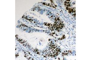 Immunohistochemical analysis of Cyclin E1 (pT395) staining in human colon cancer formalin fixed paraffin embedded tissue section.