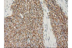 Immunohistochemical staining of paraffin-embedded Adenocarcinoma of Human breast tissue using anti-CTNNB1 mouse monoclonal antibody.