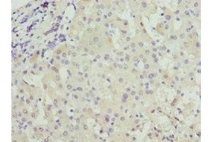 Immunohistochemistry of paraffin-embedded human liver cancer using ABIN7146036 at dilution of 1:100 (CRP Antikörper  (AA 19-224))