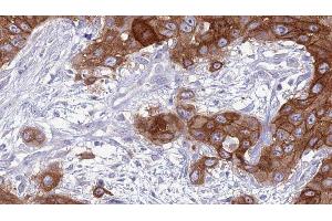 ABIN6277037 at 1/100 staining Human Head and neck cancer tissue by IHC-P. (CD83 Antikörper  (Internal Region))