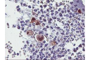 Immunohistochemical staining of paraffin-embedded Adenocarcinoma of Human colon tissue using anti-SDS mouse monoclonal antibody. (serine Dehydratase Antikörper)