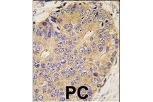 Formalin-fixed and paraffin-embedded human prostata carcinoma tissue reacted with B antibody (Center) (ABIN388450 and ABIN2848765) , which was peroxidase-conjugated to the secondary antibody, followed by DAB staining.