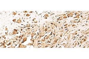Immunohistochemistry of paraffin-embedded Human prost ate cancer tissue using TERF1 Polyclonal Antibody at dilution of 1:30(x200) (TRF1 Antikörper)