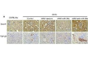 MiR-30c reduced fibrosis in DN via reducing TGF-β1 secretion from TECs.