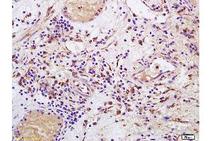 Formalin-fixed and paraffin embedded human bladder carcinoma labeled with Anti-CD158 Polyclonal Antibody, Unconjugated (ABIN748463) at 1:200 followed by conjugation to the secondary antibody and DAB staining. (KIR2DL4/CD158d Antikörper  (AA 51-150))