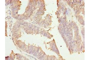Immunohistochemistry of paraffin-embedded human endometrial cancer using ABIN7166006 at dilution of 1:100 (RER1 Antikörper  (AA 85-139))