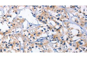Immunohistochemistry of paraffin-embedded Human thyroid cancer using CAPZA2 Polyclonal Antibody at dilution of 1:30 (CAPZA2 Antikörper)
