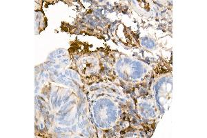 Immunohistochemistry of paraffin-embedded Human colon carcinoma using Human IgG antibody (ABIN7267844) at dilution of 1:300 (40x lens). (IGHG1 Antikörper)