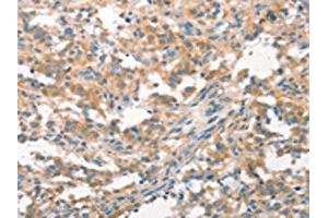 The image on the left is immunohistochemistry of paraffin-embedded Human thyroid cancer tissue using ABIN7193053(WNK3 Antibody) at dilution 1/20, on the right is treated with synthetic peptide. (WNK3 Antikörper)