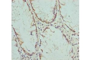 Immunohistochemistry of paraffin-embedded human colon cancer using ABIN7148459 at dilution of 1:100
