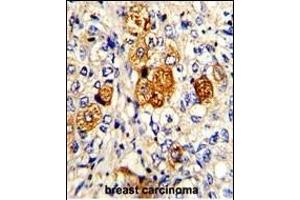 Formalin-fixed and paraffin-embedded human breast carcinoma with C5 Antibody (N-term), which was peroxidase-conjugated to the secondary antibody, followed by DAB staining. (C5 Antikörper  (N-Term))