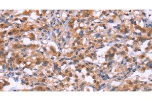 Immunohistochemistry of paraffin-embedded Human thyroid cancer tissue using BRK1 Polyclonal Antibody at dilution 1:30 (BRK1 Antikörper)
