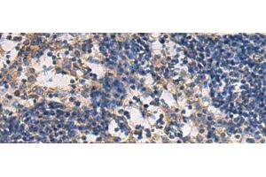 Immunohistochemistry of paraffin-embedded Human esophagus cancer tissue using DMRTA2 Polyclonal Antibody at dilution of 1:50(x200) (DMRTA2 Antikörper)