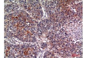 Immunohistochemistry (IHC) image for anti-Interleukin 13 Receptor, alpha 2 (IL13RA2) (Internal Region) antibody (ABIN6282532)