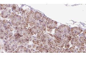 ABIN6273246 at 1/100 staining Human pancreas cancer tissue by IHC-P. (FXR1 Antikörper  (Internal Region))