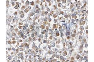 ABIN6268680 at 1/100 staining human breast tissues sections by IHC-P. (alpha Fetoprotein Antikörper  (C-Term))