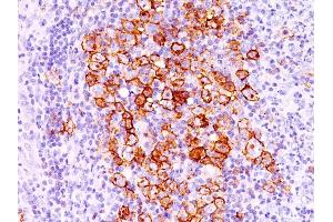 Formalin-fixed, paraffin-embedded human Hodgkin's lymphoma stained with CD30 Ab (CD30/412). (TNFRSF8 Antikörper)